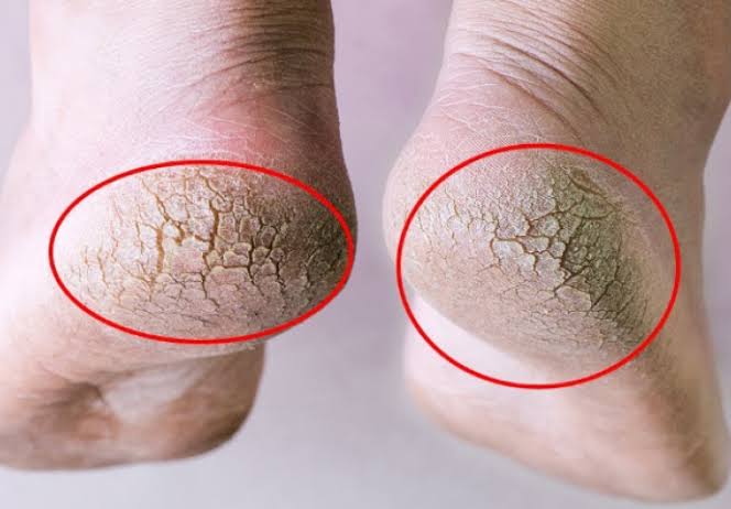 Uklonite zadebljalu kožu sa peta: Žena (57) otkriva sjajan recept od dva sastojka! - featured image Uklonite zadebljalu kožu sa peta: Žena (57) otkriva sjajan recept od dva sastojka! - featured image